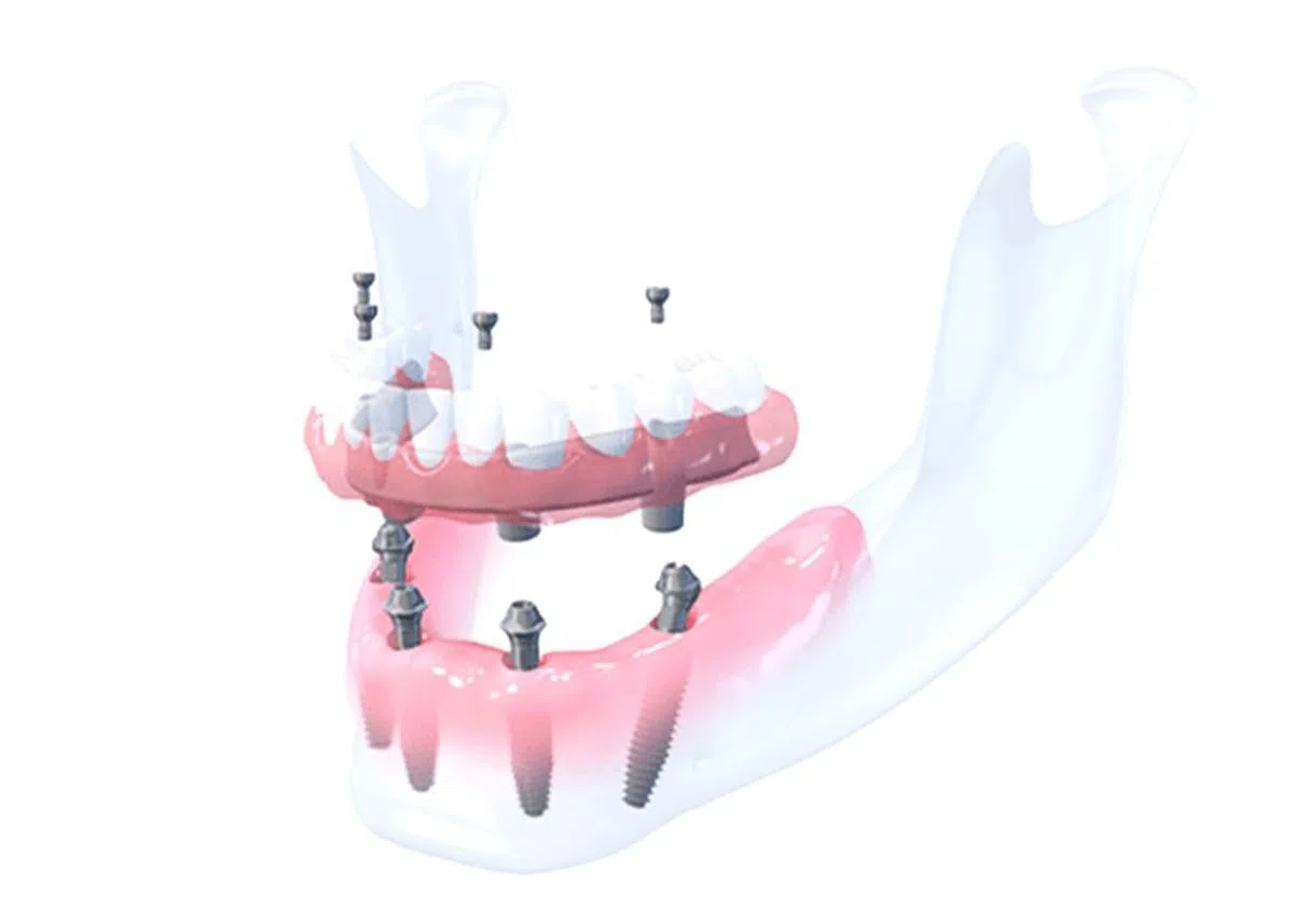 经过良好训练、经验丰富的牙医通过Pro-Arch植牙程序为患者执行牙齿重建。（图/T32牙科中心提供）