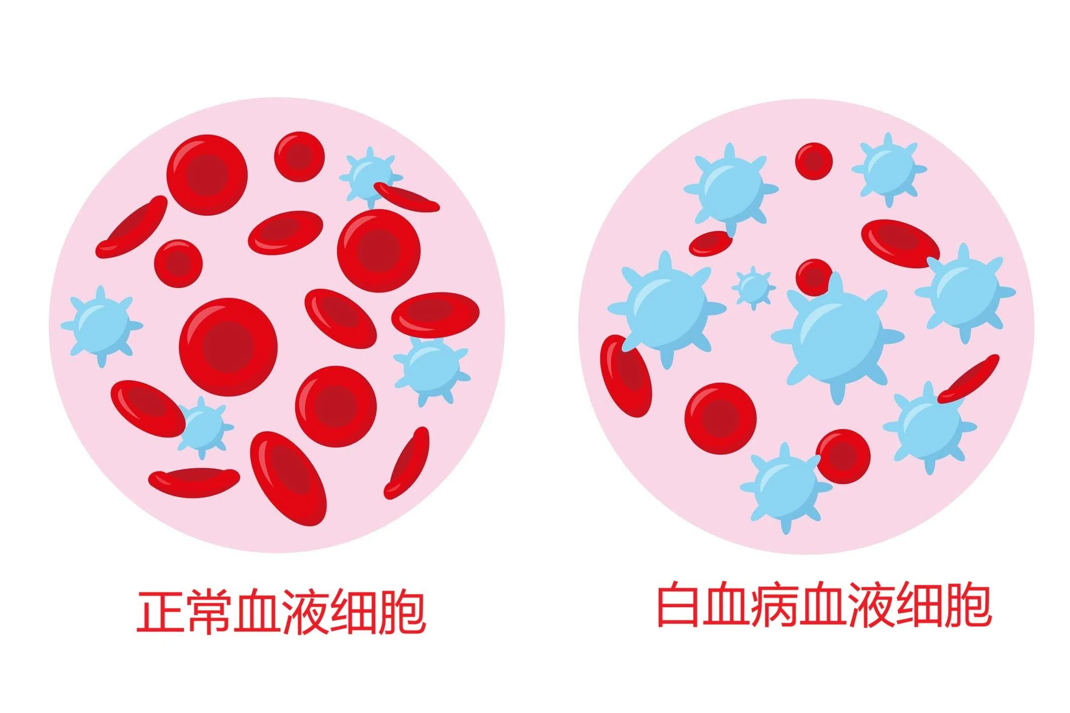 正常血液细胞（左）与白血病血液细胞（右边）癌变的差异。（iStock图片）