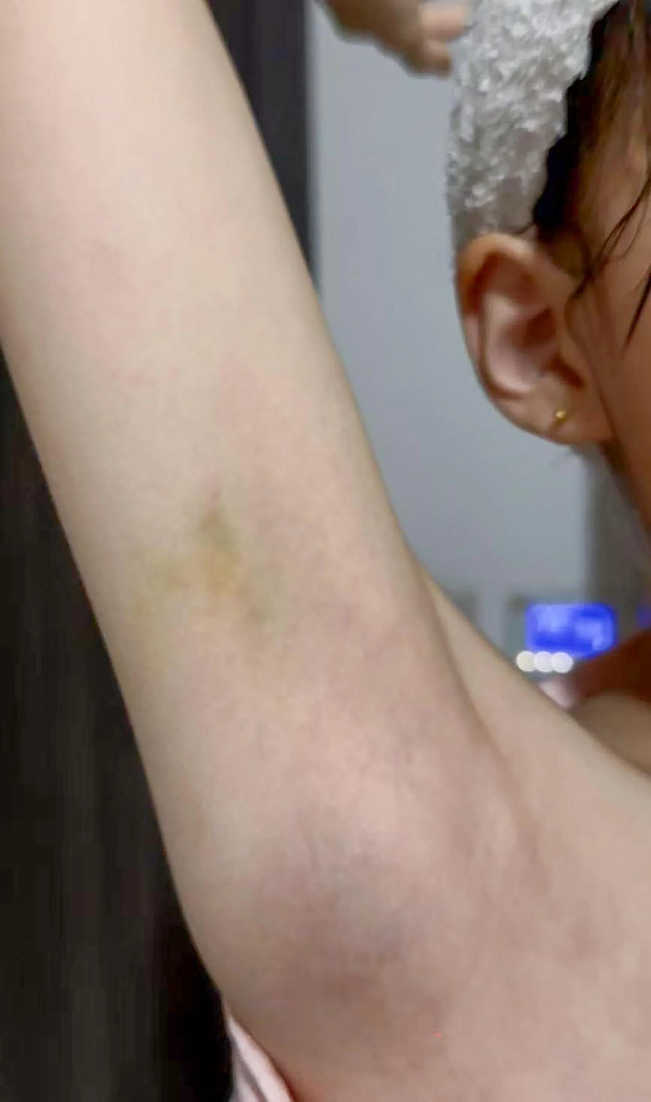 殷妮发现女儿手臂内侧有淤青后带她去医院开验伤证明。（受访者提供）