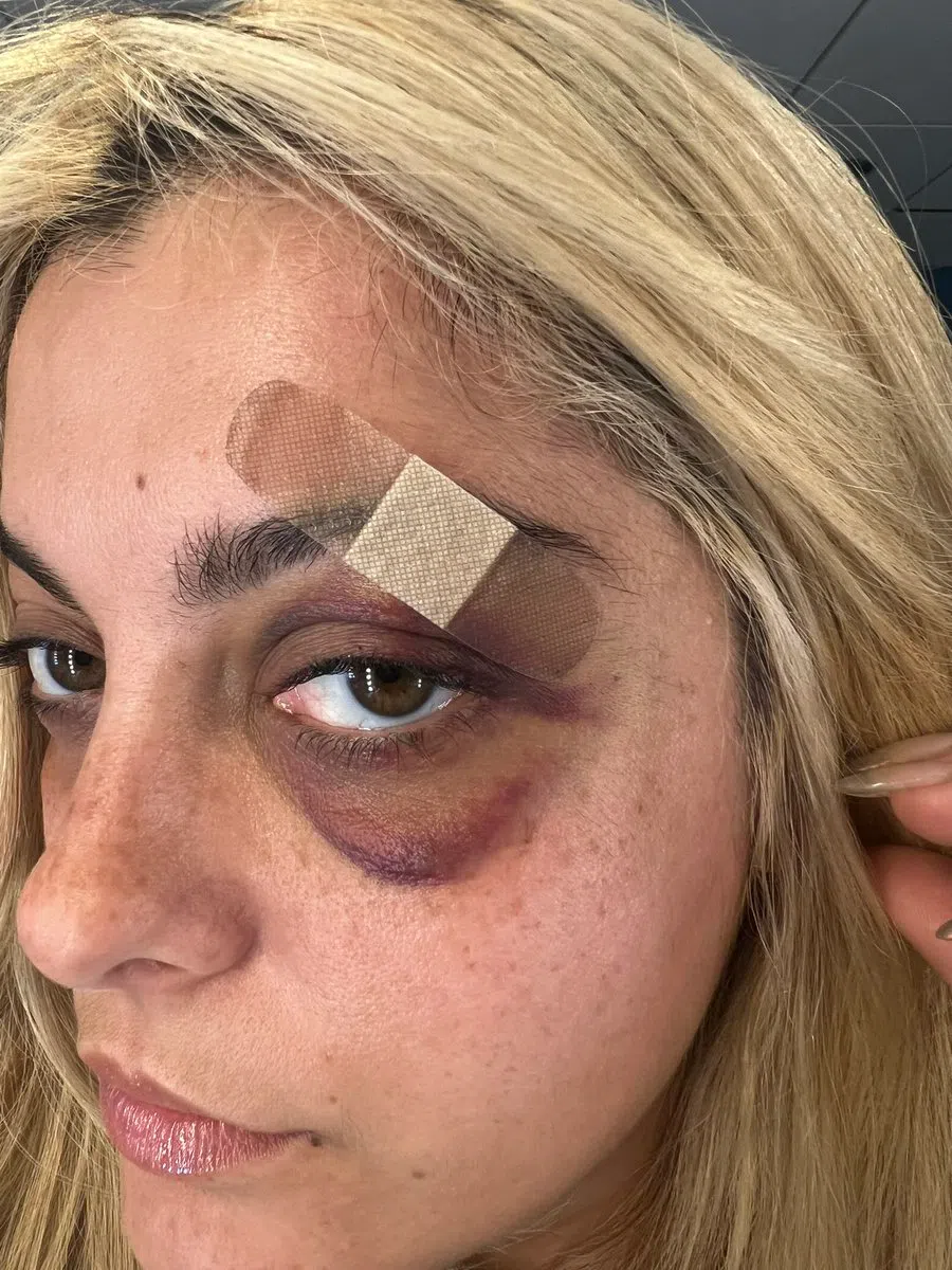 美国创作歌手Bebe Rexha在台上被横空飞来的手机击伤左眼。（互联网）