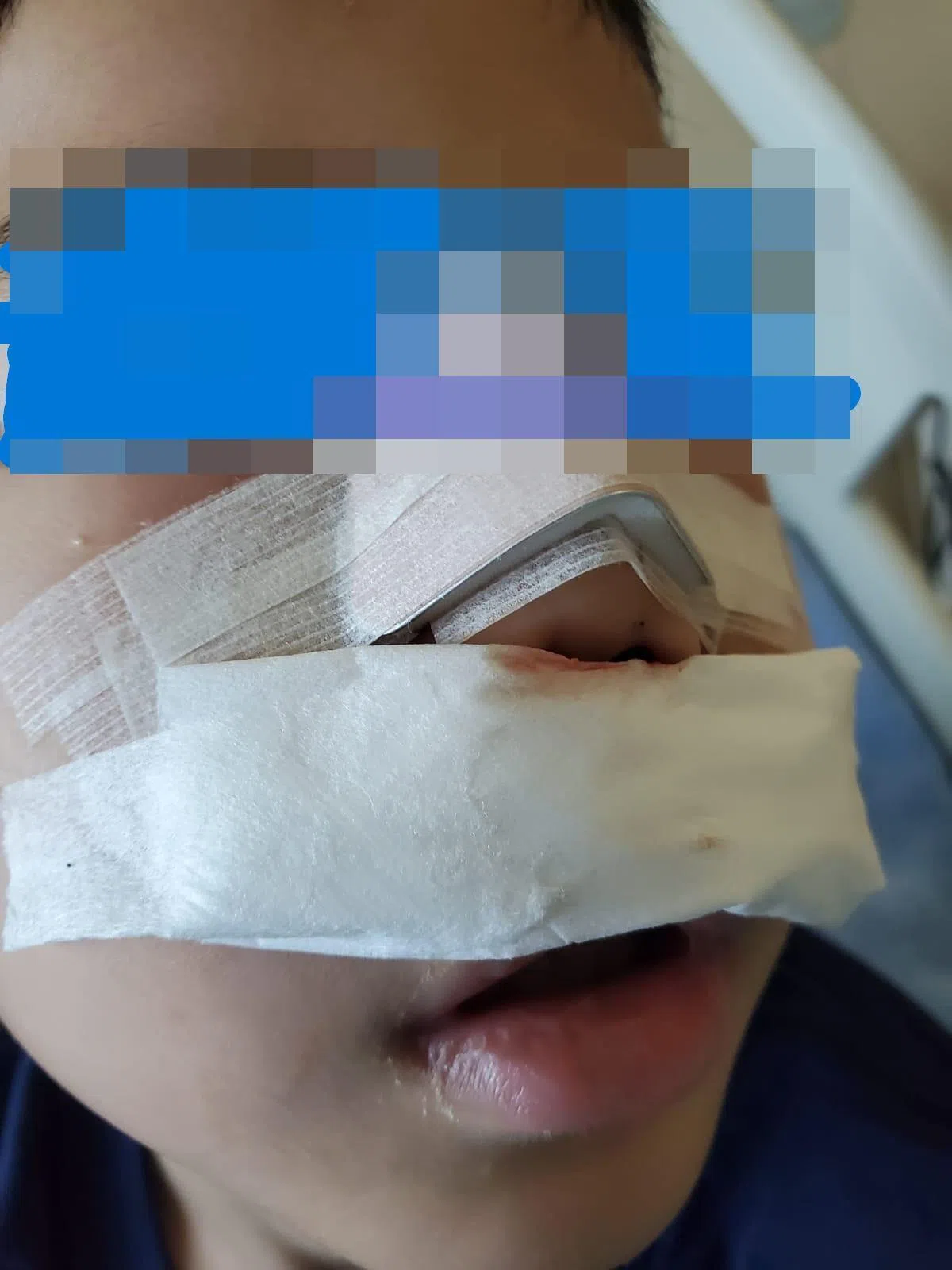 6岁男童隔天进行全麻手术修复鼻梁骨和开放性伤口，缝了超过30针。医生已经尽量将创口减到最小，但仍会留下一道永久性疤痕。（受访者提供）