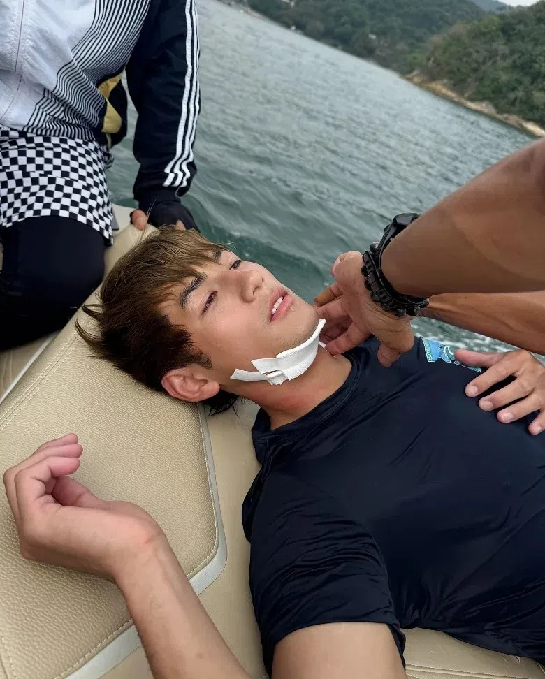 魏浚笙拍戏出意外。（取自魏浚笙IG。）