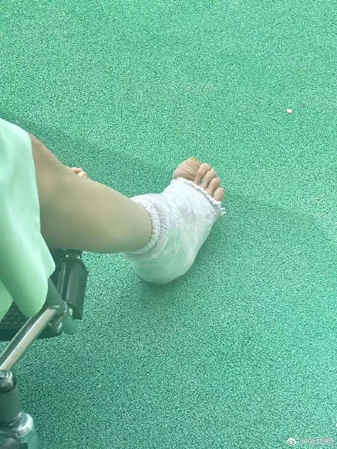 张雨绮脚踝包着纱布。（取自张雨绮工作室微博）