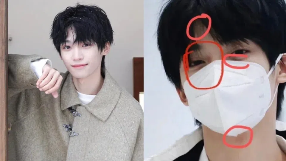 光合少年成员梓渝被发现脸上有多处淤青，粉丝怀疑他被殴打。（互联网）