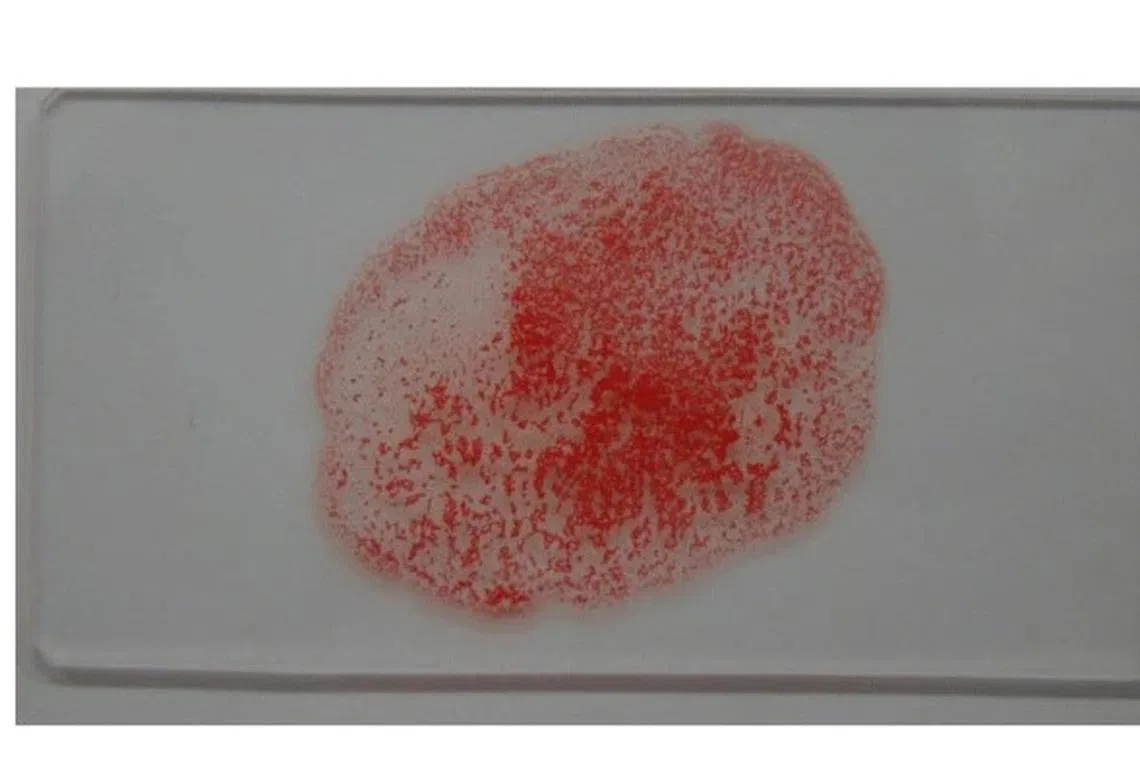 血液的凝集反应，大量红血球聚集成团。（互联网）