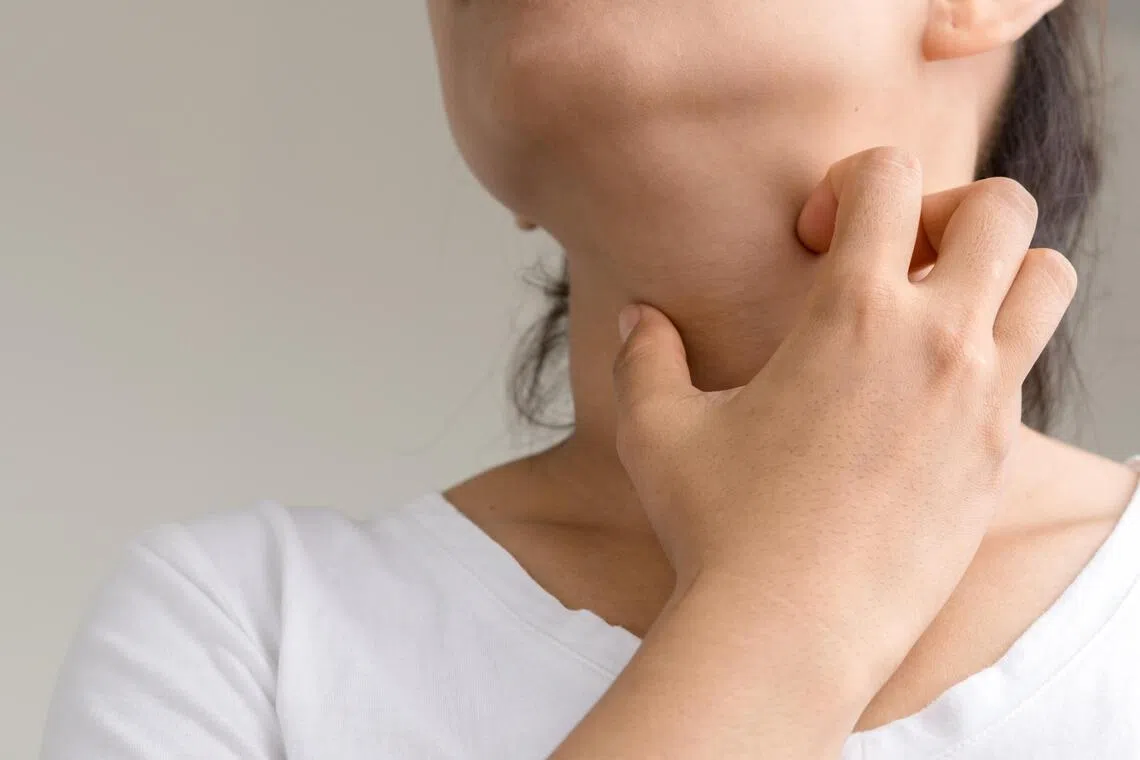 特应性皮炎也叫湿疹，是本地最常见的皮肤疾病，影响约11%的成年和约两成儿童人口。（档案照片）