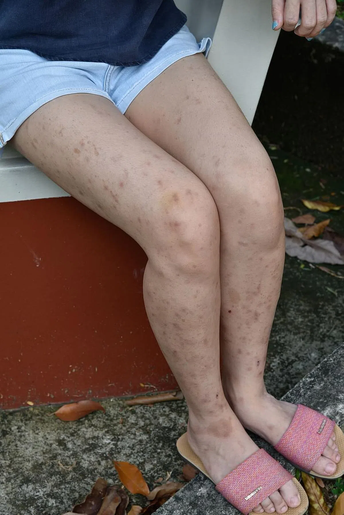 NF1患者的临床特征包括身体多处出现扁平与牛奶咖啡色的斑疹。（伍书永摄）