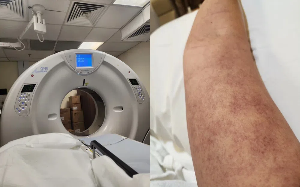 瑞恩求医后做了不同的扫描，右图为右手臂肿胀及出现瘀伤的照片（取自瑞恩IG）