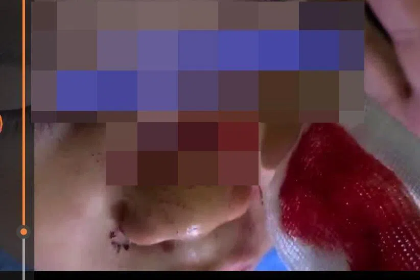 6岁男童在星耀樟宜摔倒致鼻梁骨折 家长吁加强防护措施