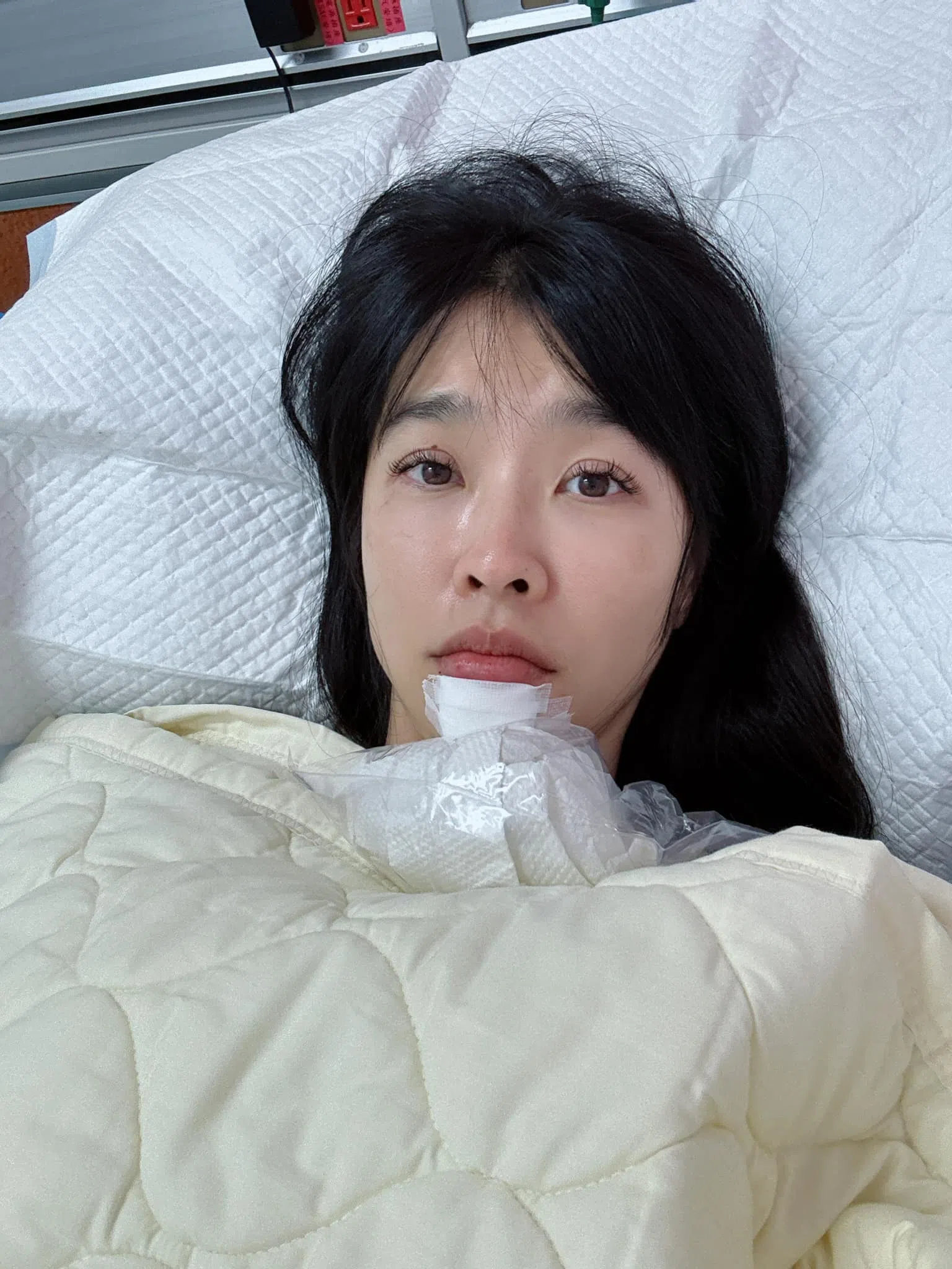 小娴休养期间须戴三个月维持器。（取自艺人脸书）
