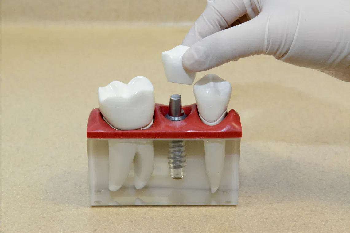 旅途中不慎跌倒导致牙冠损坏，并找当地牙医修复。回国后，这笔治疗费是否可以索赔存在不确定因素。（海峡时报档案照）