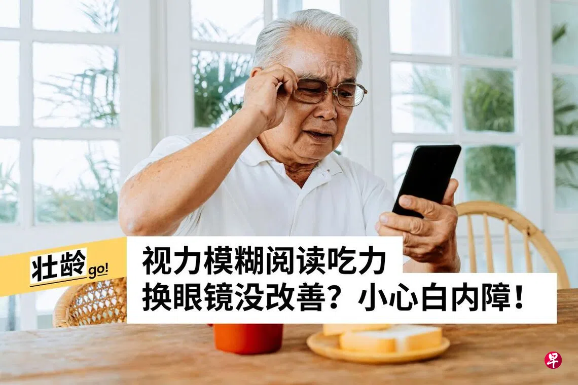 白内障不必等“熟透” 早期阶段可安全摘除