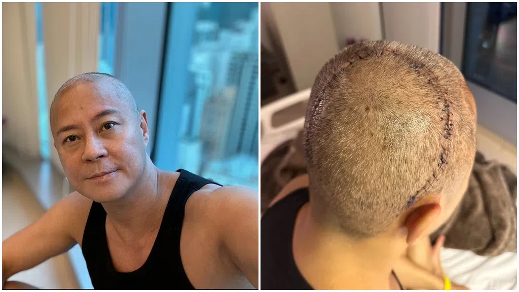 2024年10月，蔡一杰在社媒公布自己刚做完切除脑部肿瘤的手术，后脑杓留下约40公分倒U型缝合痕迹照片。（互联网）