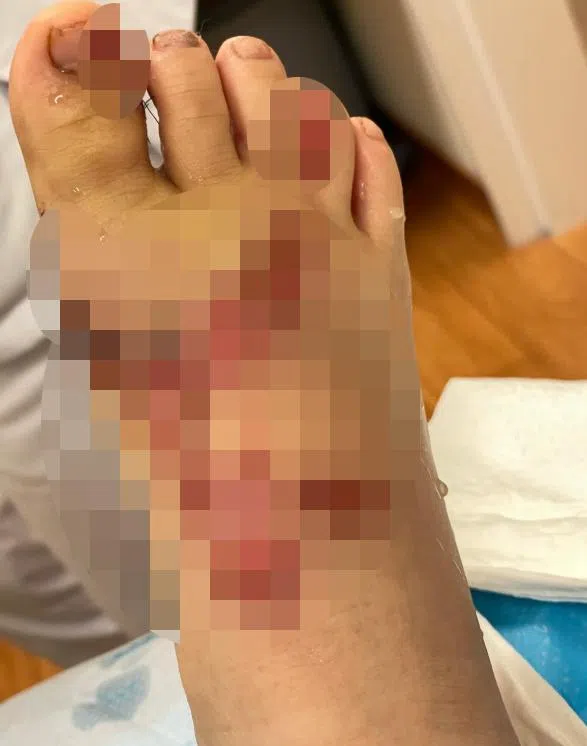 事故后断裂的人字拖特写画面（受访者供图）