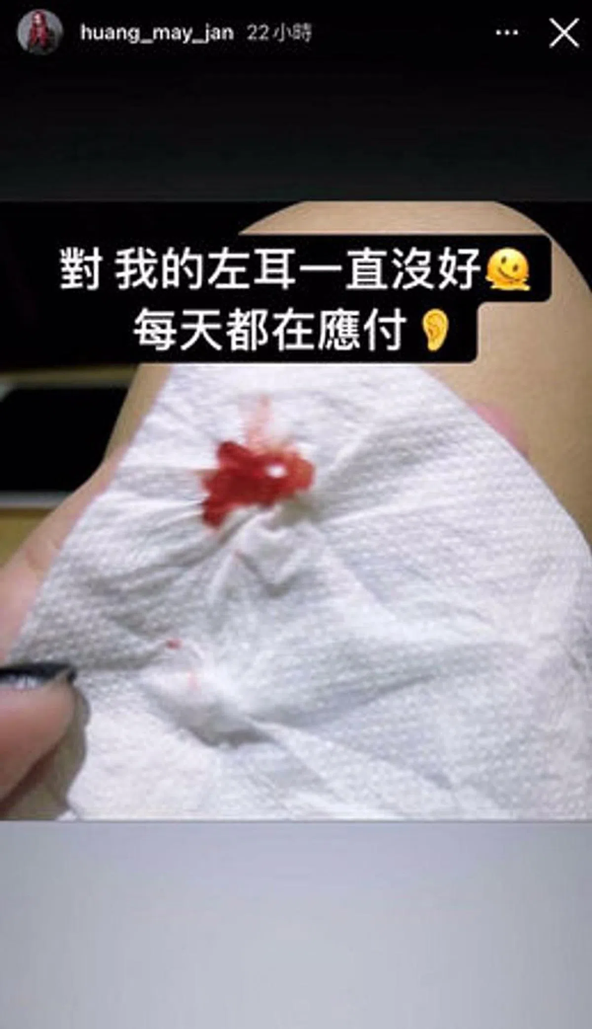 黄美珍在社媒上传耳朵流血的照片。（互联网）