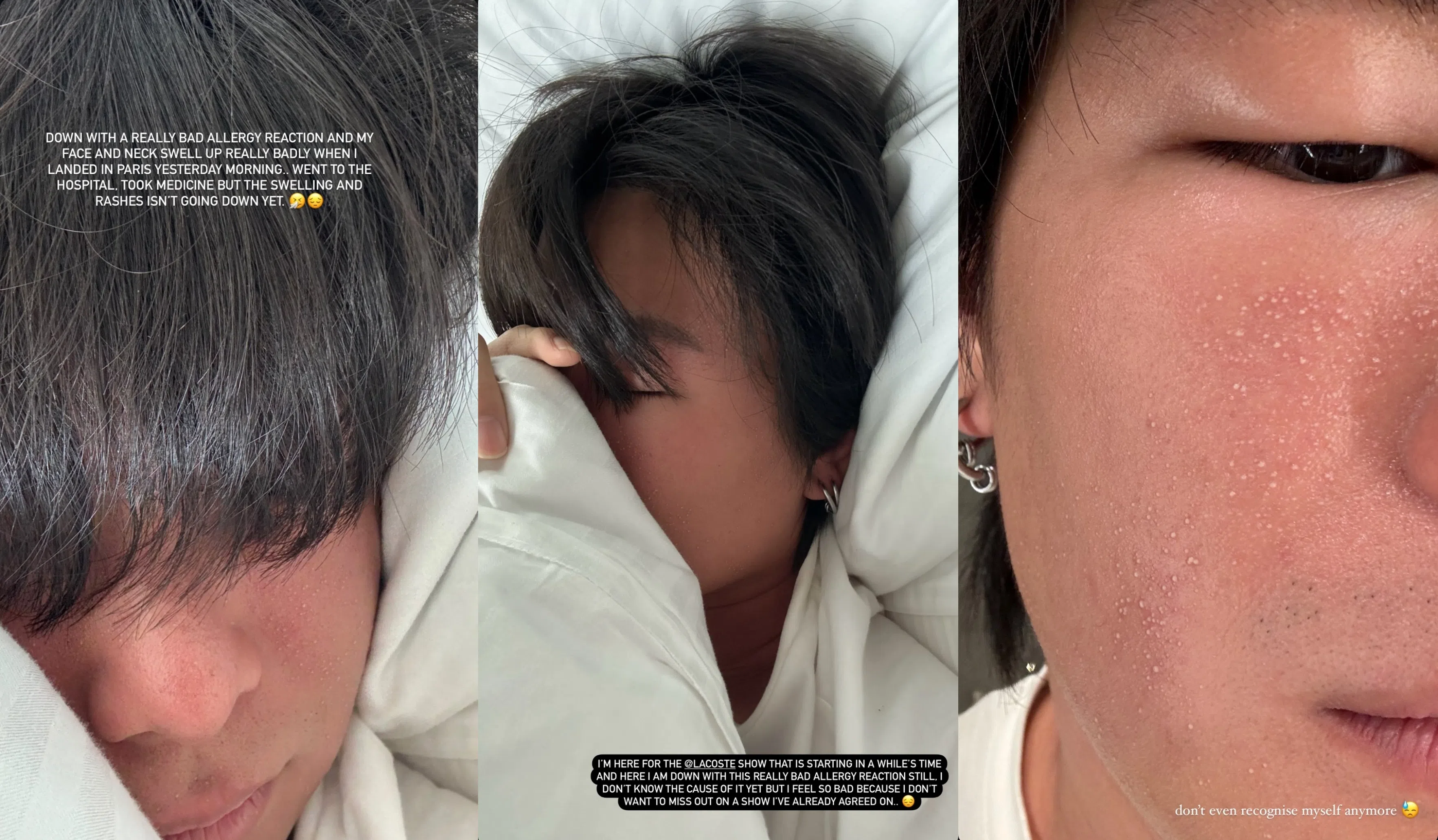 容启航的脸及脖子都因过敏而红肿。（截自容启航IG）