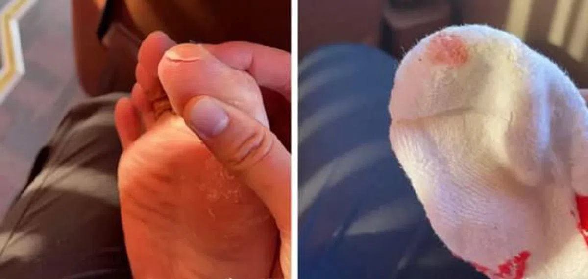 因右脚的鞋头开裂，陈雨菲的大脚趾被钢丝戳伤。（微博“BWF世界羽联”）