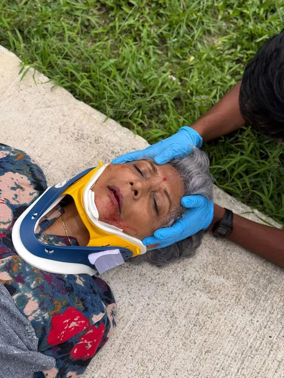 电动脚踏车从背后撞上玛拉，导致她下巴先着地，下颚三处骨折。幸运的是，新加坡民防部队的救护车正好经过，为她进行紧急护理。（受访者提供）
