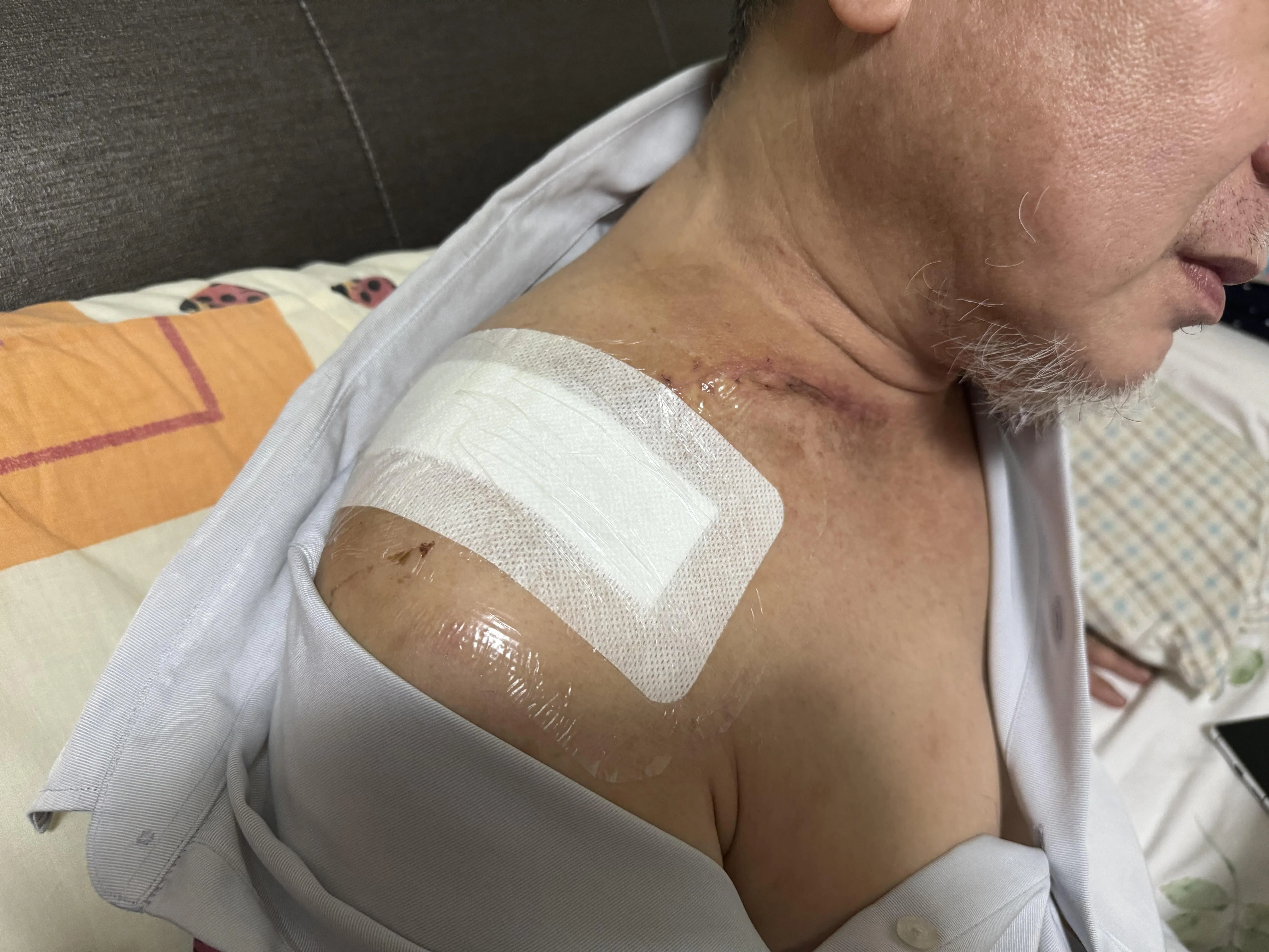 肩胛骨有约15公分的伤疤，还有一个小伤口没愈合。（王丝绮摄）