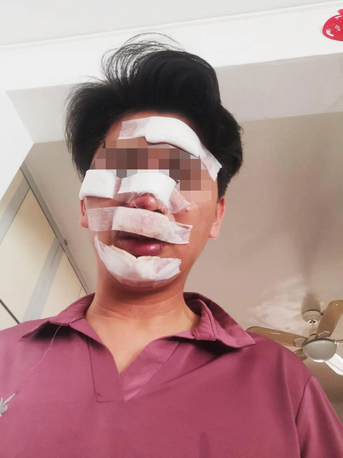 木木的父亲被匪徒撞倒在地，造成左臂、双手以及面部受伤，掉了两颗牙，另有两颗牙被撞断。（受访者提供）