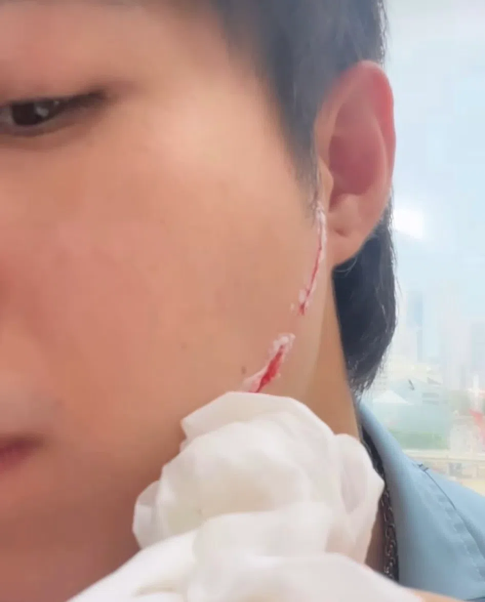 宗子杰在拍摄途中挂彩。（取自宗子杰IG）