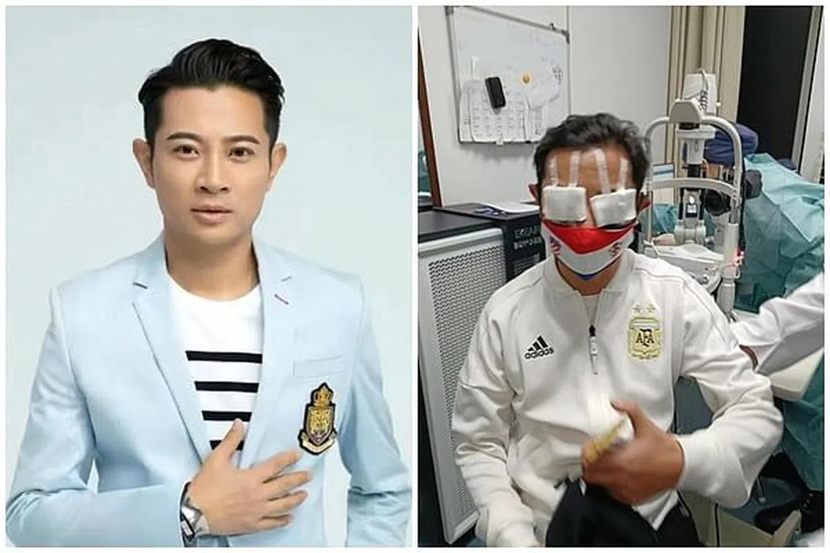 罗中旭看完世界杯，找朋友下场踢球，不幸踢伤眼睛。（取自微博）