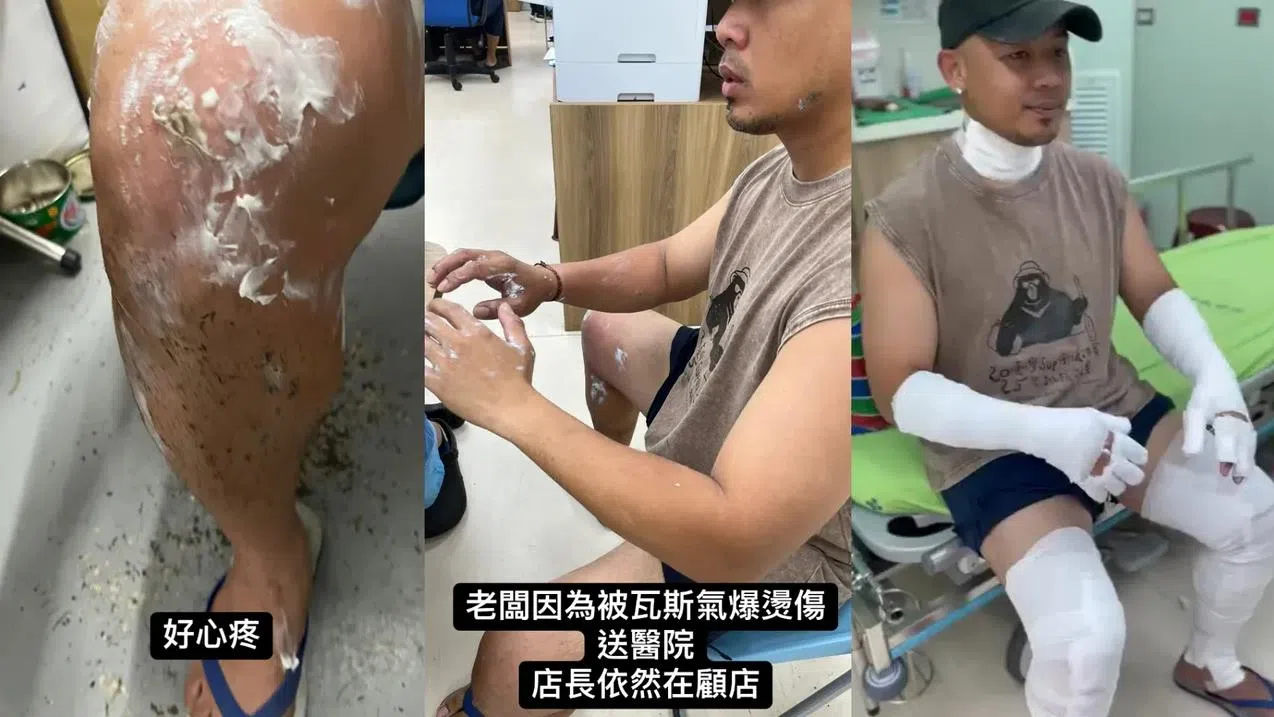 纪晓君老公遭遇瓦斯气爆，全身二度烧烫伤。（互联网）