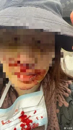 金晨公开事故受伤照。（取自金晨微博）