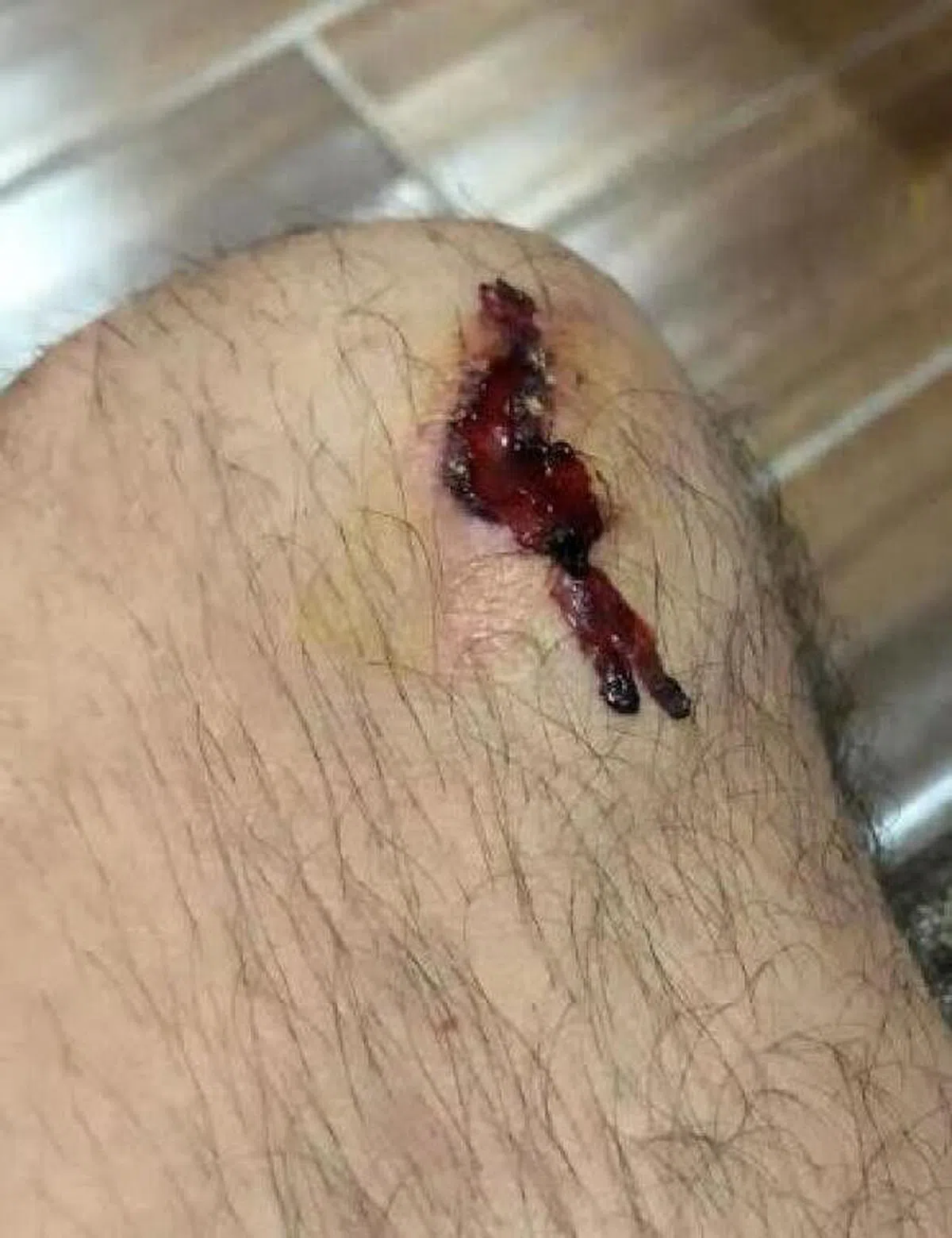 戴向宇腿部被铁钩划伤。（受访者提供）