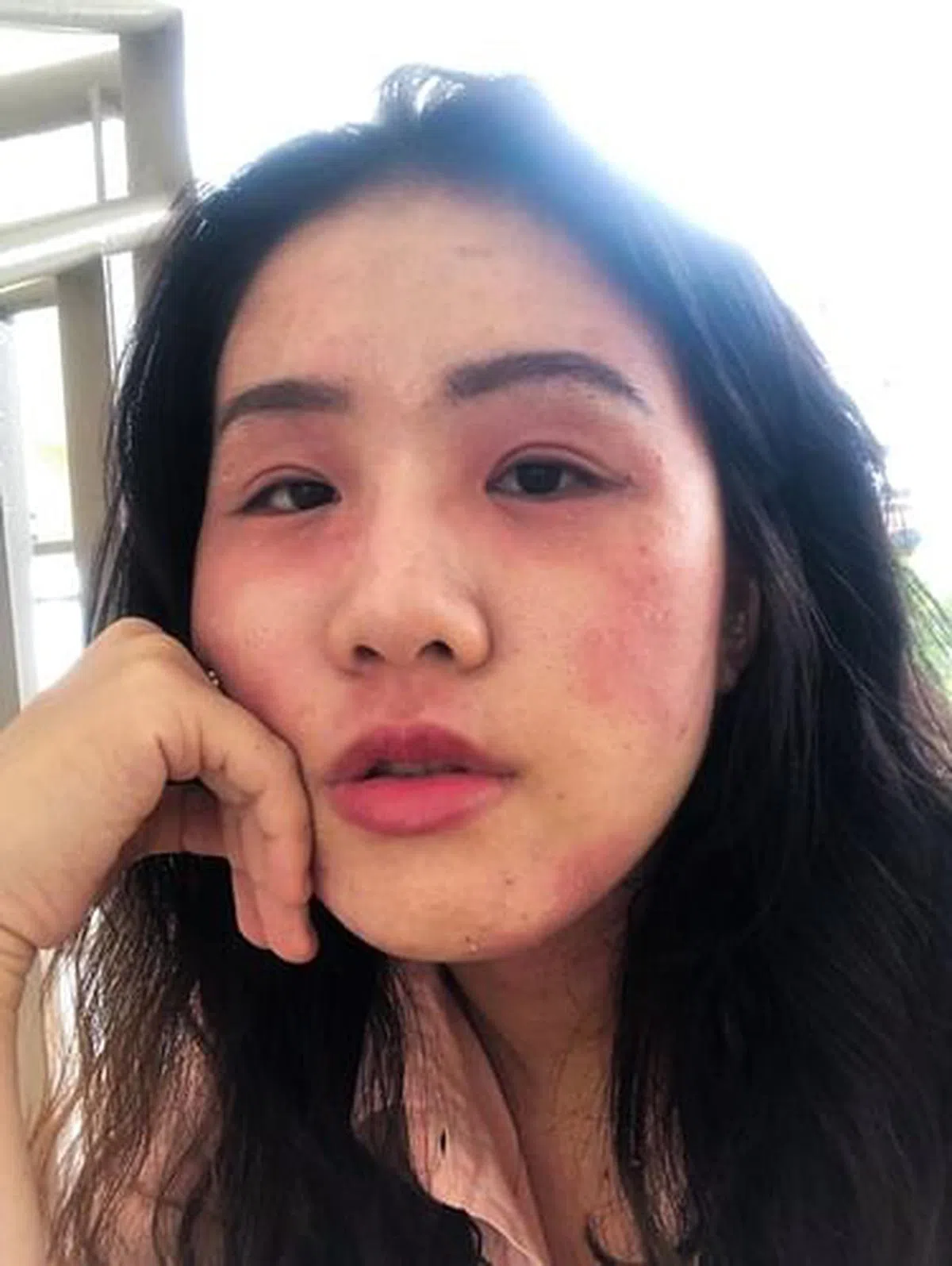 范睿琦严重的湿疹疤痕至今仍未痊愈。（图/受访者提供）