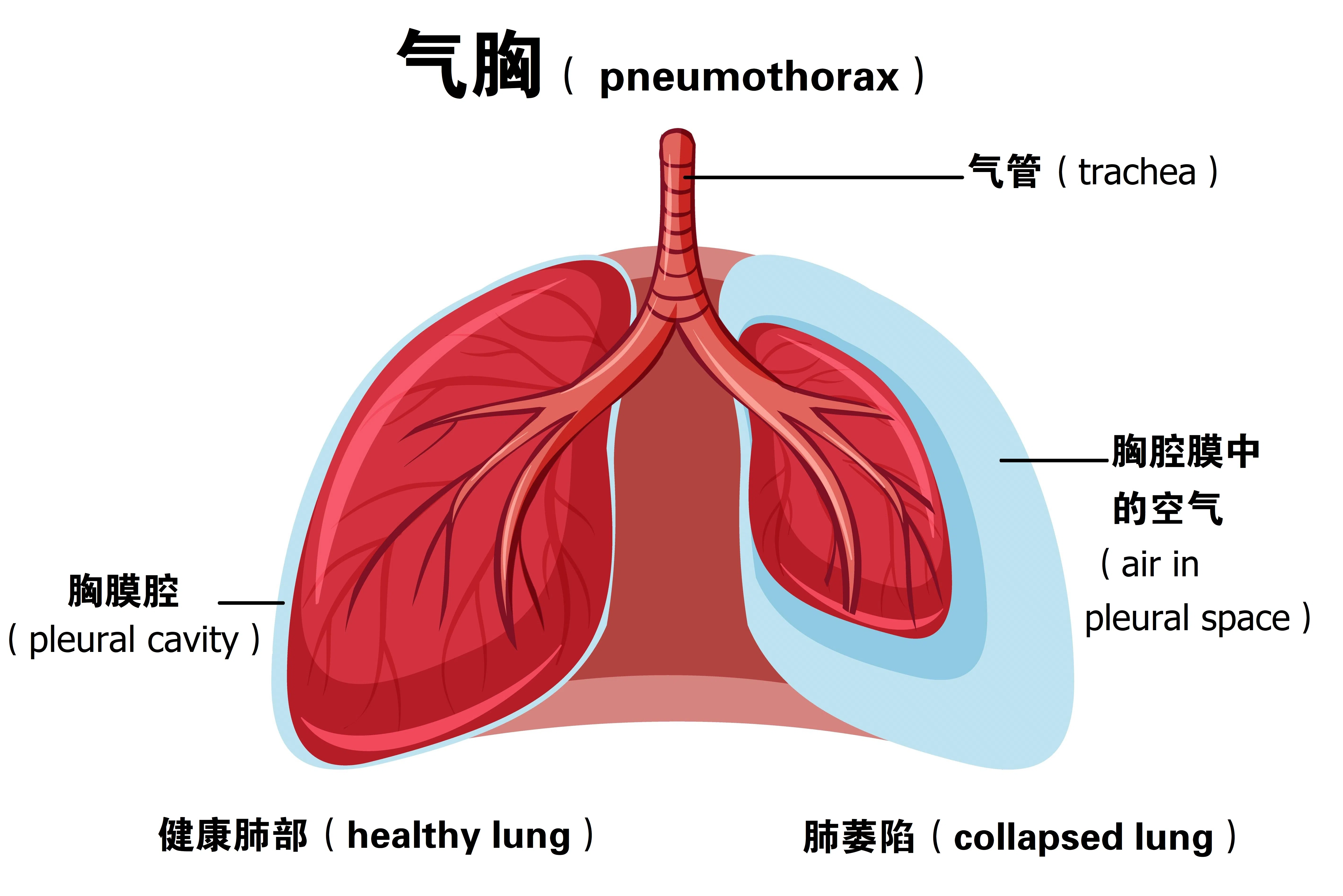 气胸意即有空气渗入原本应该密闭的胸膜腔。图的右边是受到压迫的肺部，左边是正常的肺部。（iStock图片）