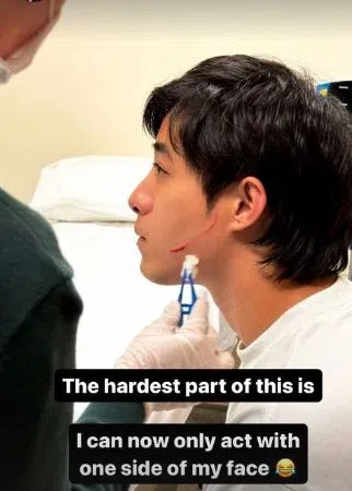 宗子杰告诉记者：“现在比较麻烦的是，拍摄时暂时只能拍右脸。”（取自宗子杰IG）