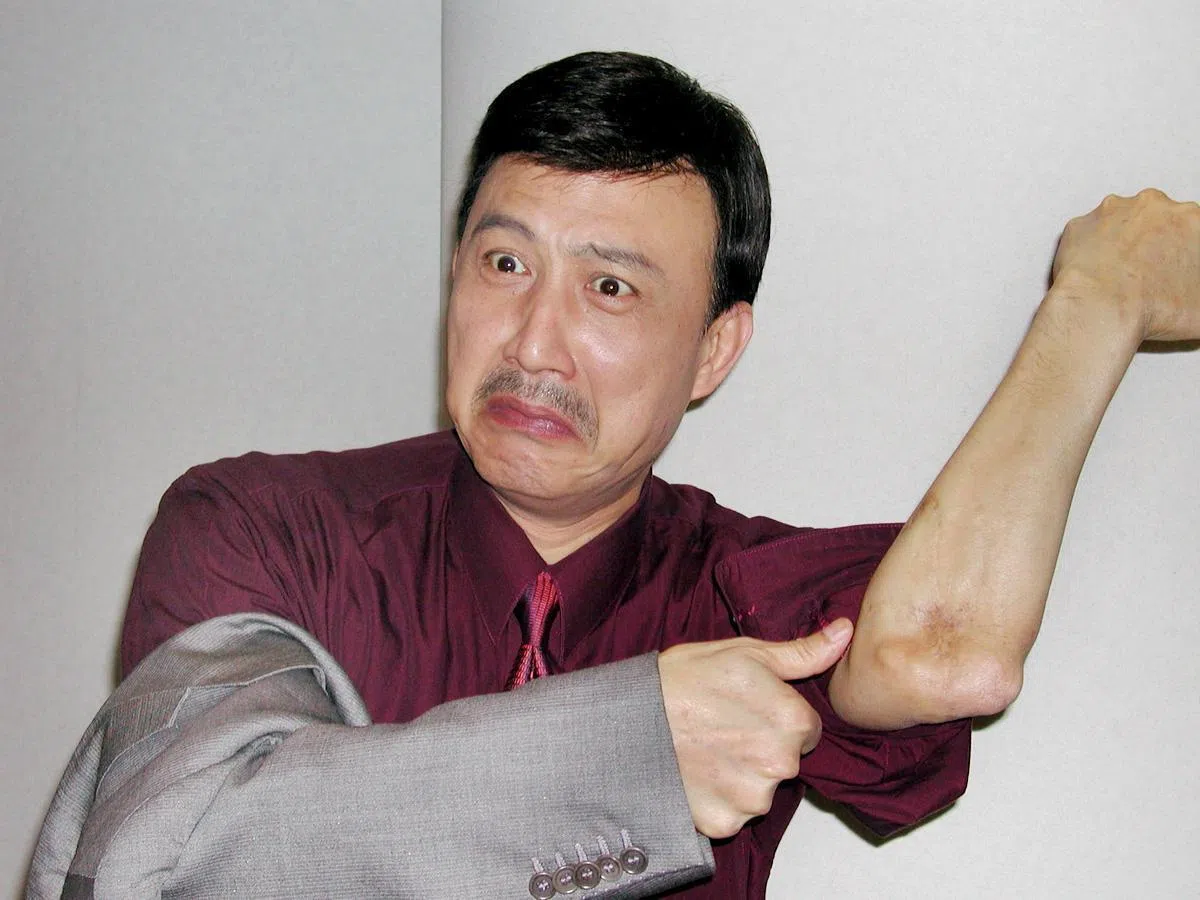 余天2001年接受本地媒体采访时曾秀出旧伤。（档案照）