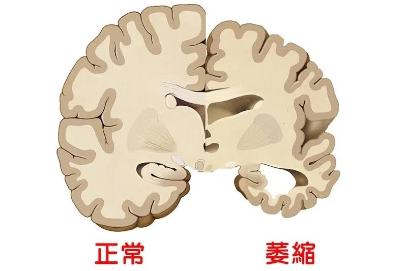 阿尔茨海默症是失智症头号杀手，会导致大脑神经元大量流失，从而引发大脑外观萎缩。（互联网）