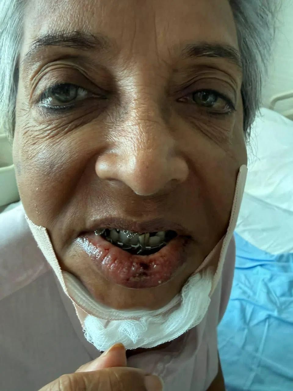 玛拉12月12日接受手术，植入三块钢板和钢丝，接下来一个多月只能吃流食。（受访者提供）