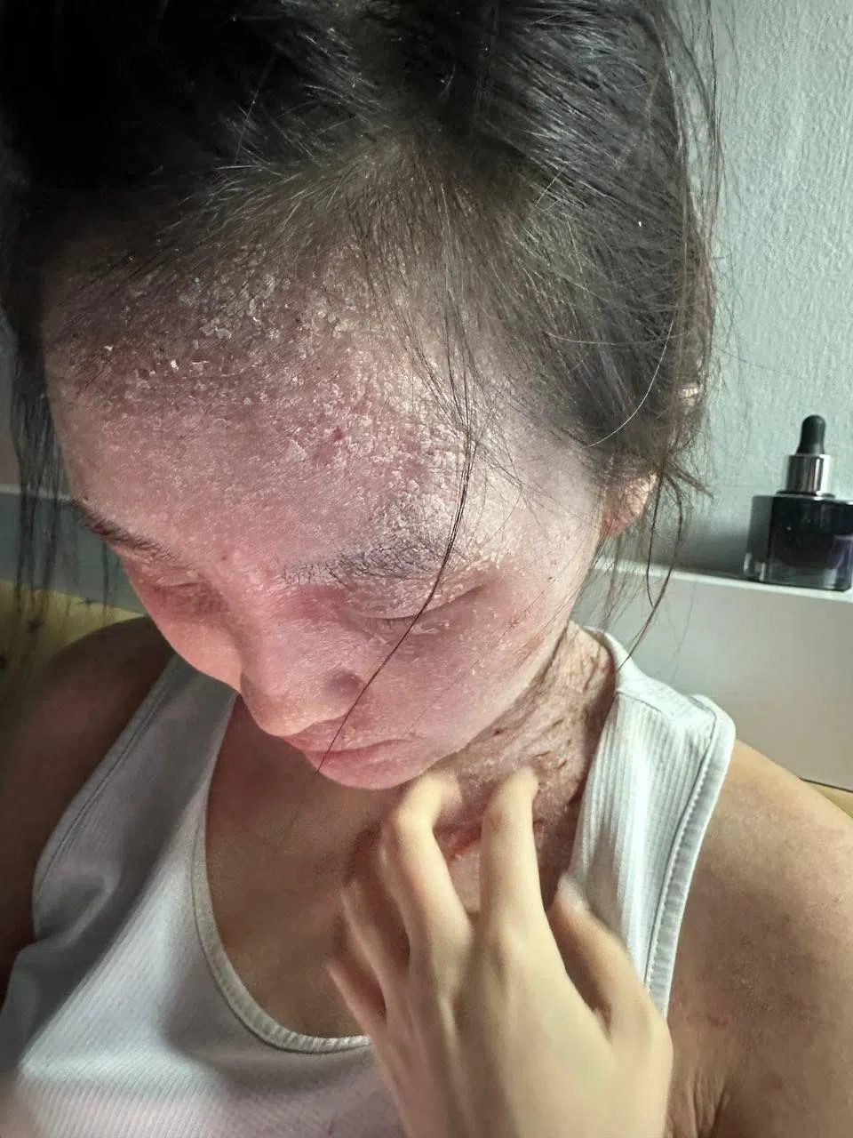 方莹慧在2024年时，因长期使用类固醇引发了严重的戒断反应，也导致整个人变了样，身心受到很大影响。（受访者提供）