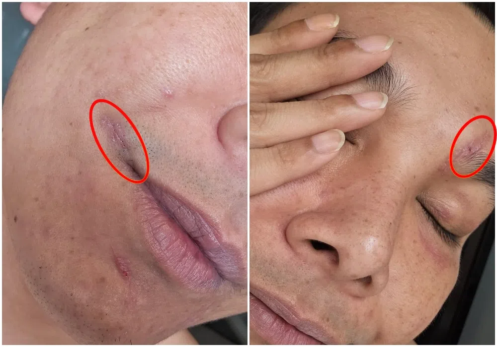 廖永谊在社媒秀出拆线后的脸部，他的眉骨碎裂未来或须进行钢片置入手术。（取自廖永谊IG）