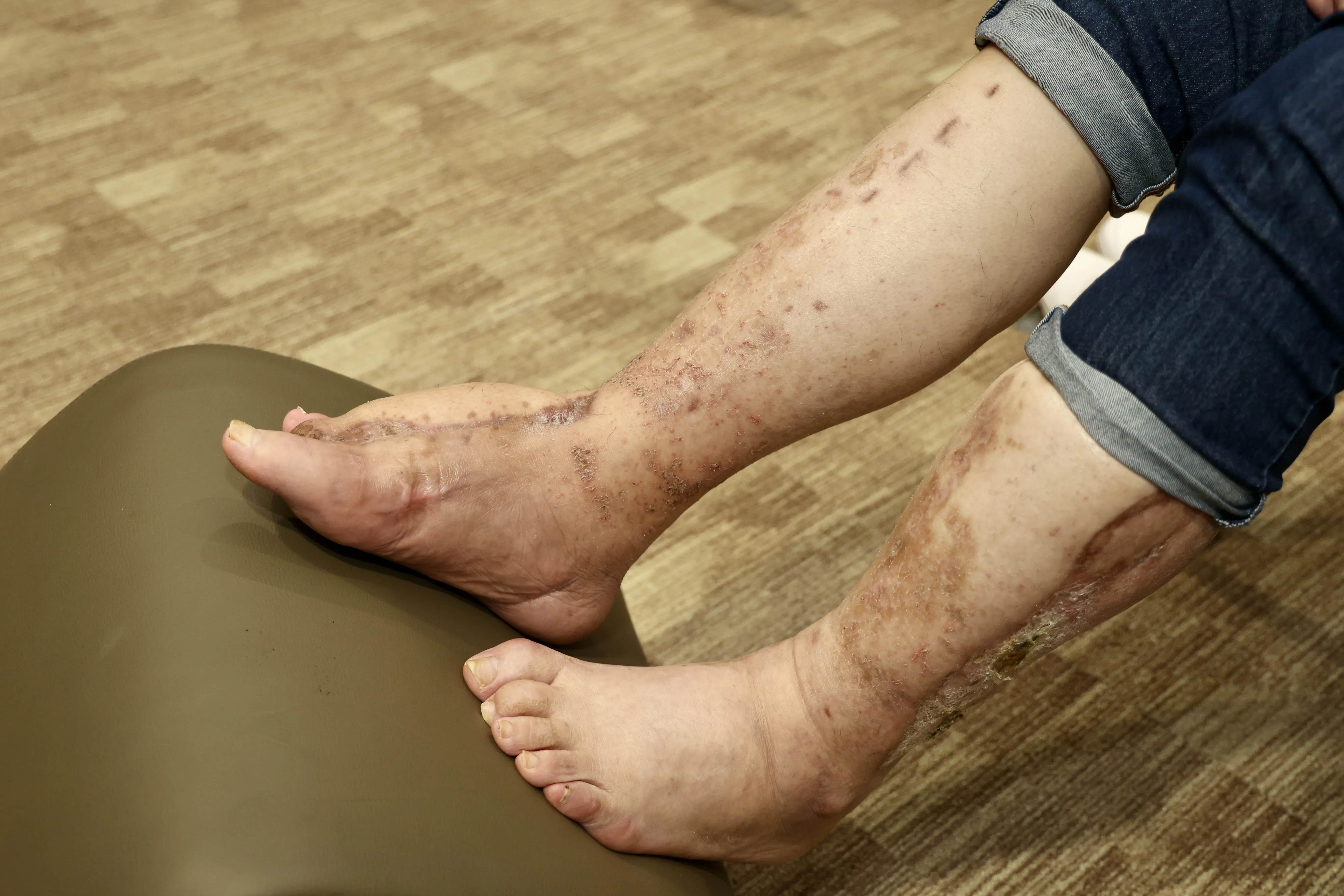 在进行TTT手术后，整形及重建手术科团队从病患健康的左腿，切割出腓骨游离皮瓣（free fibula flap），为受感染的右足重建足部。（邝启聪摄）