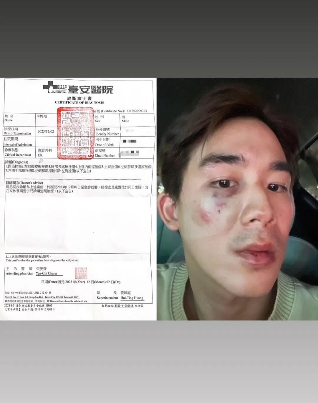 李博翔公开伤势照，自嘲“脸变成了猪头”。（取自李博翔IG）