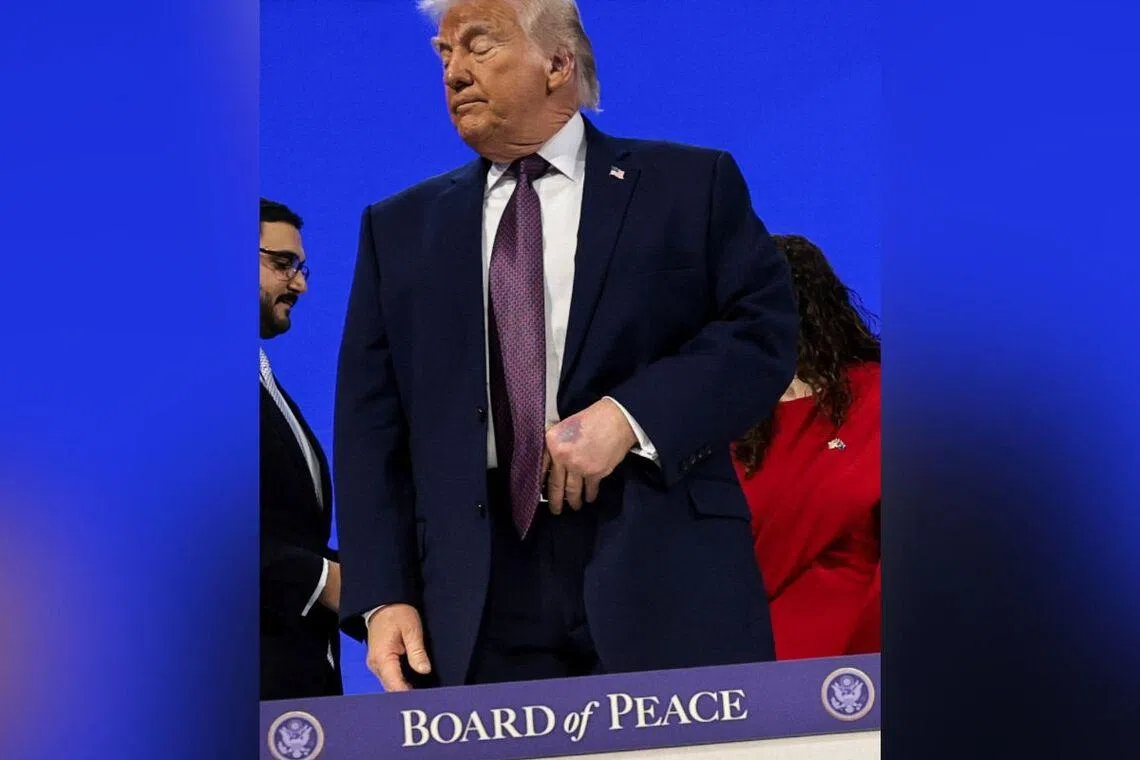 特朗普左手淤青引健康关注