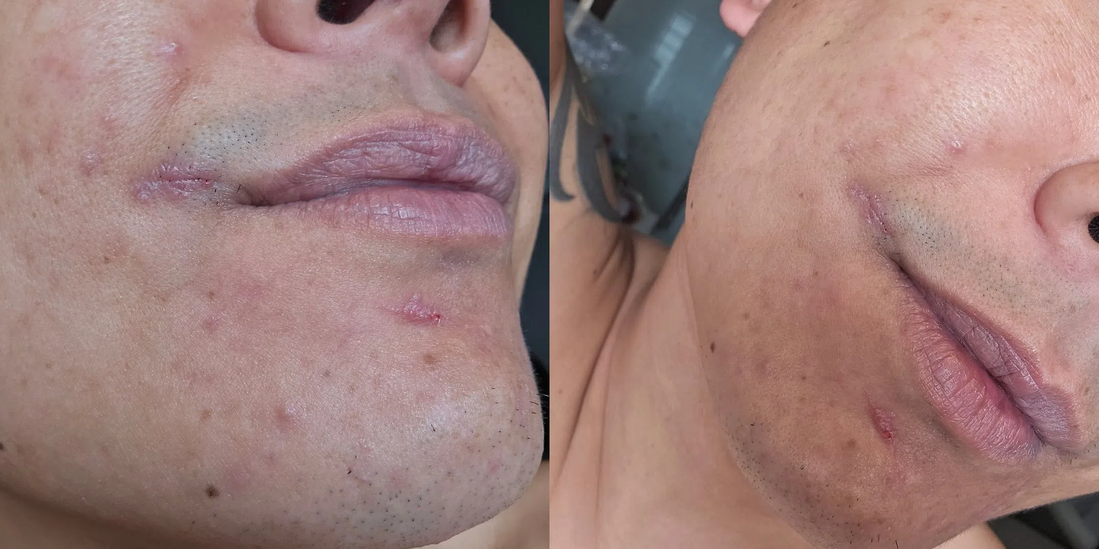 廖永谊的嘴角和下巴处都留下疤痕。（取自廖永谊IG）