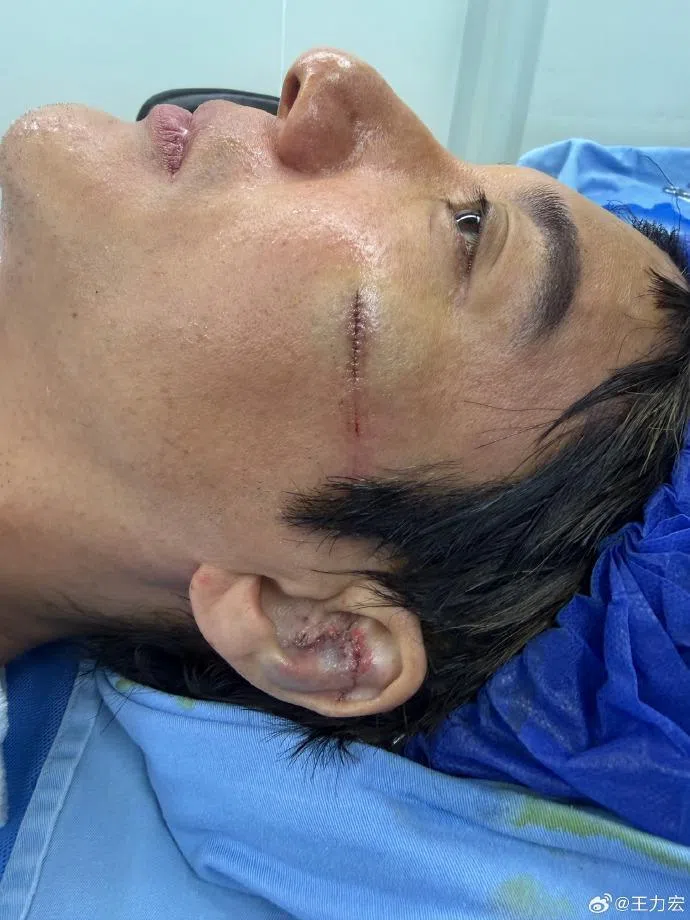王力宏帅脸破相，左耳伤势颇为严重。（互联网）