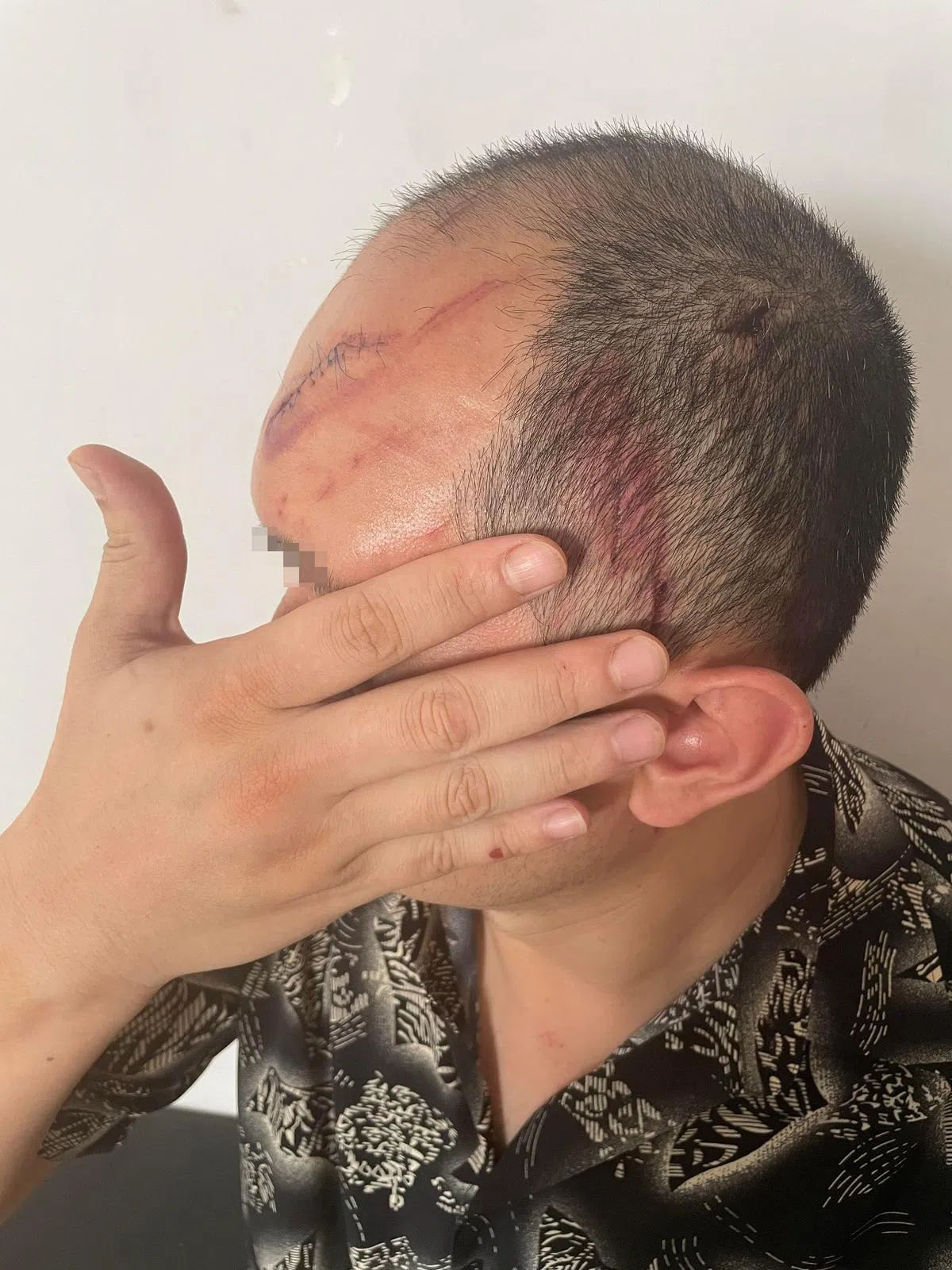 陈先生头部缝了七针。（吴依瑾摄）