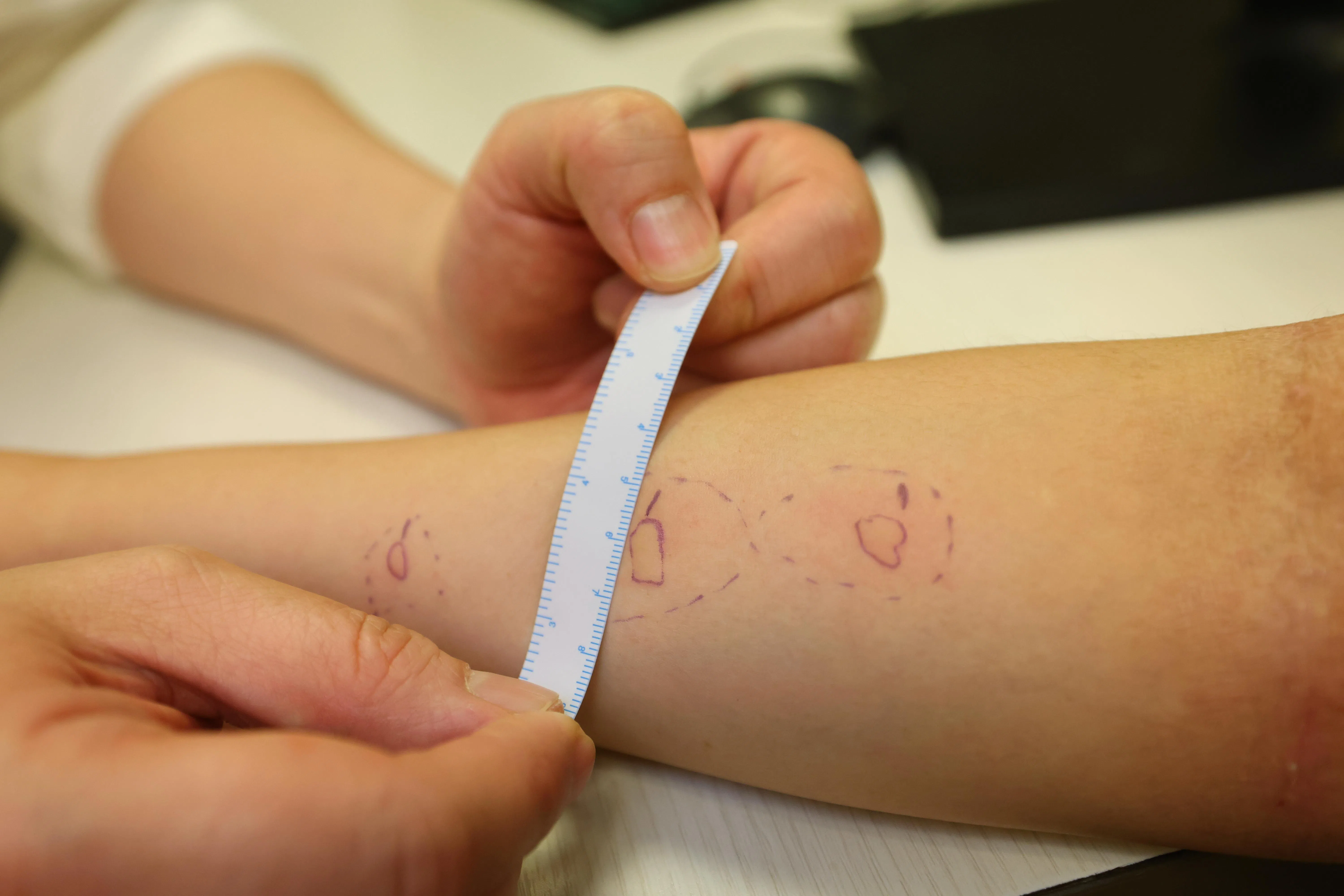 皮肤点刺试验是一种将少量致敏原液体刺入患者皮肤表层的测试，如患者对过敏原过敏，会在15分钟内在点刺部位出现红肿块。（唐家鸿摄）