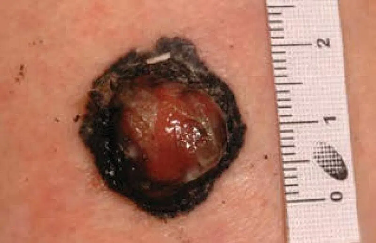 黑色素细胞癌。（图／全国皮肤中心） 
