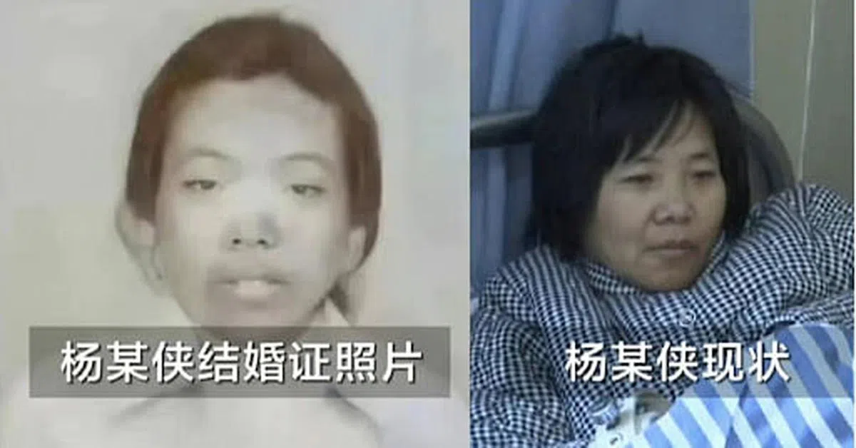 江苏广电旗下短视频账号荔视频发布杨某侠（右）在医院的视频，网民截图后与多年前的“结婚照”作对比，许多人表示难以相信这是同一人。（互联网）