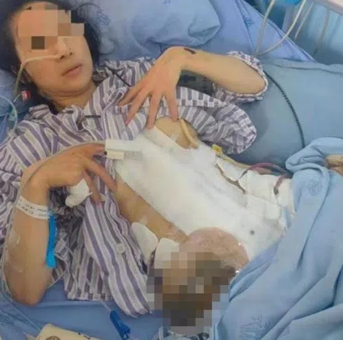 前夫的家暴导致谢女士肋骨骨折、小肠梗阻等，需要终生挂着粪袋生活。（互联网）