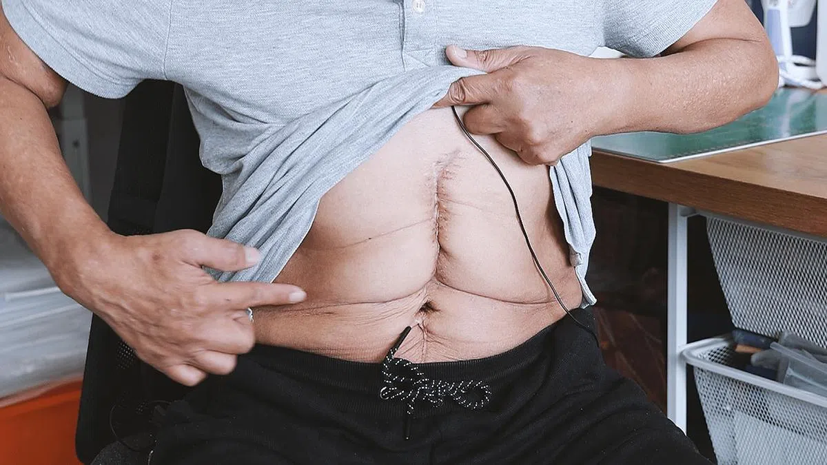 换肝手术后，张志成缝了57针，在腹部留下了深深的疤痕。