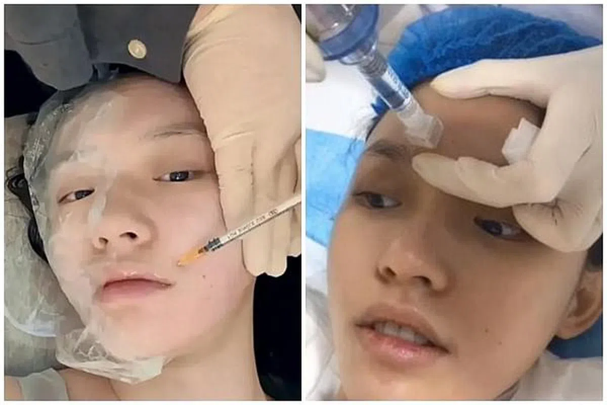 林允公开个人的整容体验。（视频截图）