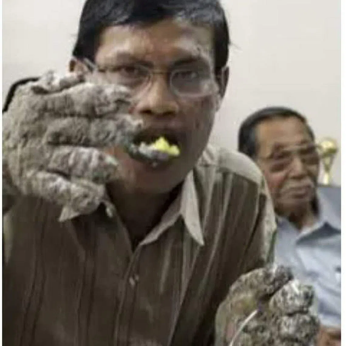 印尼的克斯瓦尔生前动了去除手上肉瘤的手术后，还可以用汤匙吃饭。（互联网）